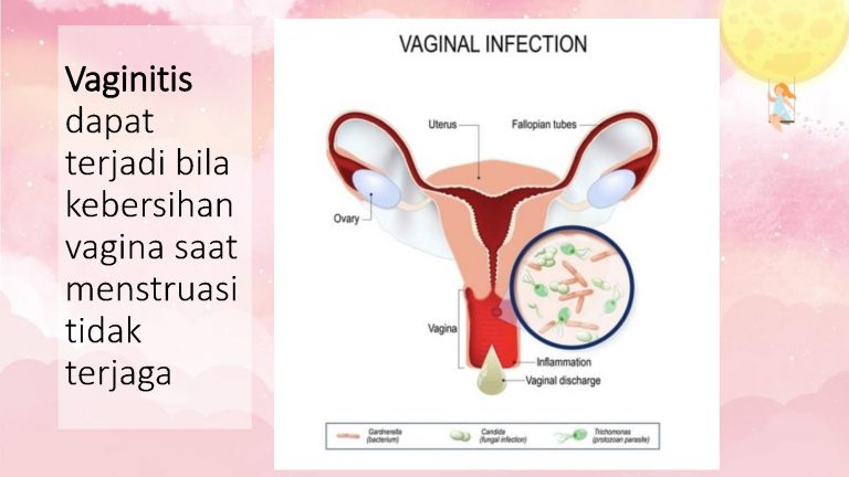 infeksi vagina