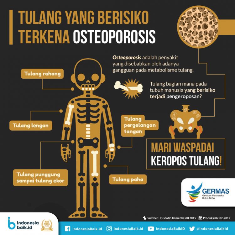 penyebab osteoporosis di usia muda