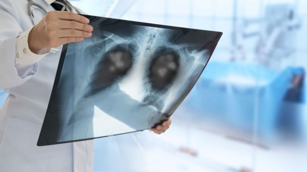 waspada gejala pneumonia