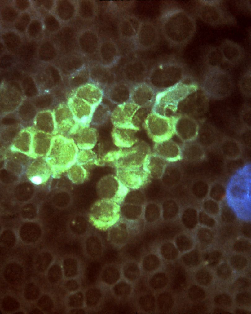penyebab herpes zoster