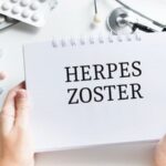 herpes zoster